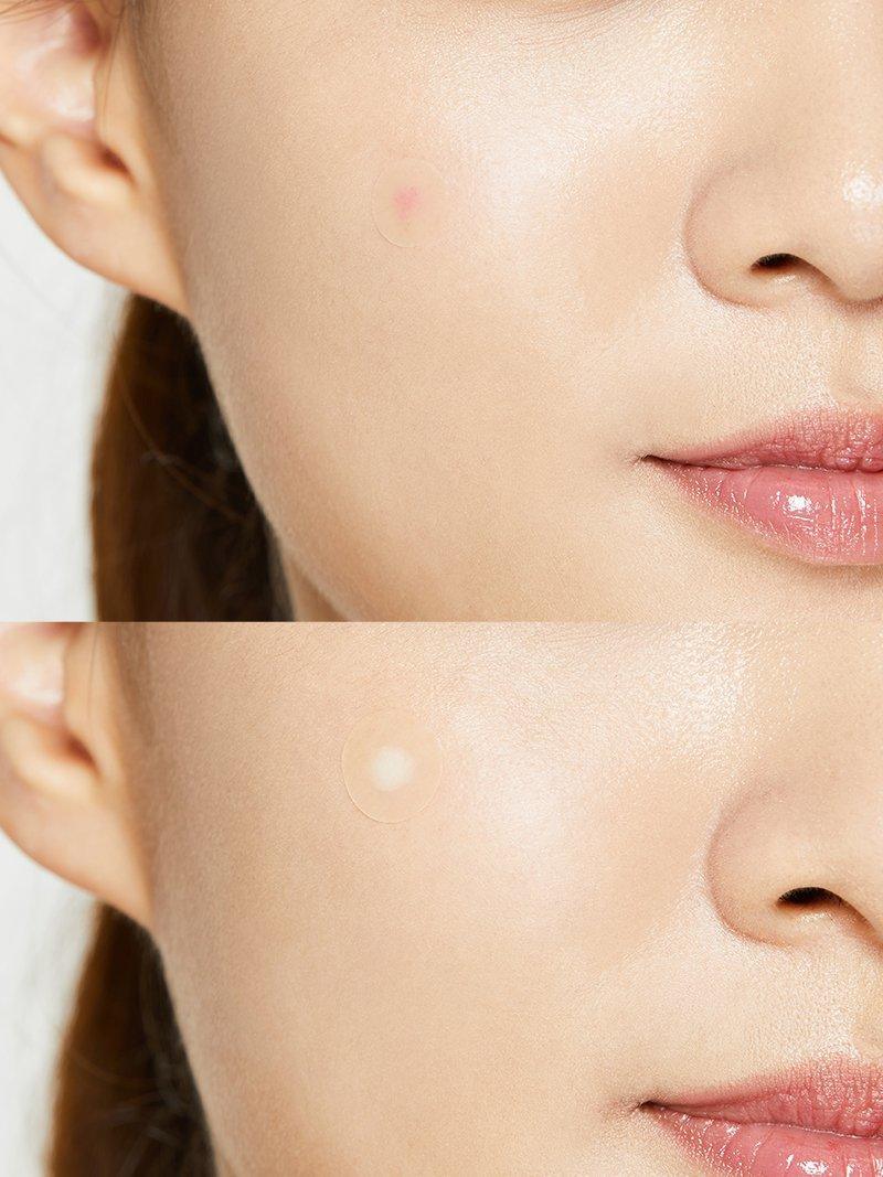 cosrx-acne-pimple-master-patch-pickelpatch-hydrokolloid image 5
