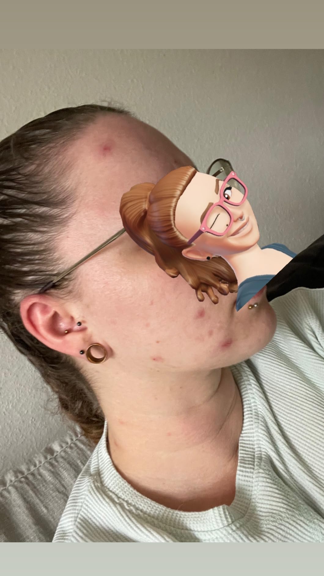 Hilft gegen Maskenpickel