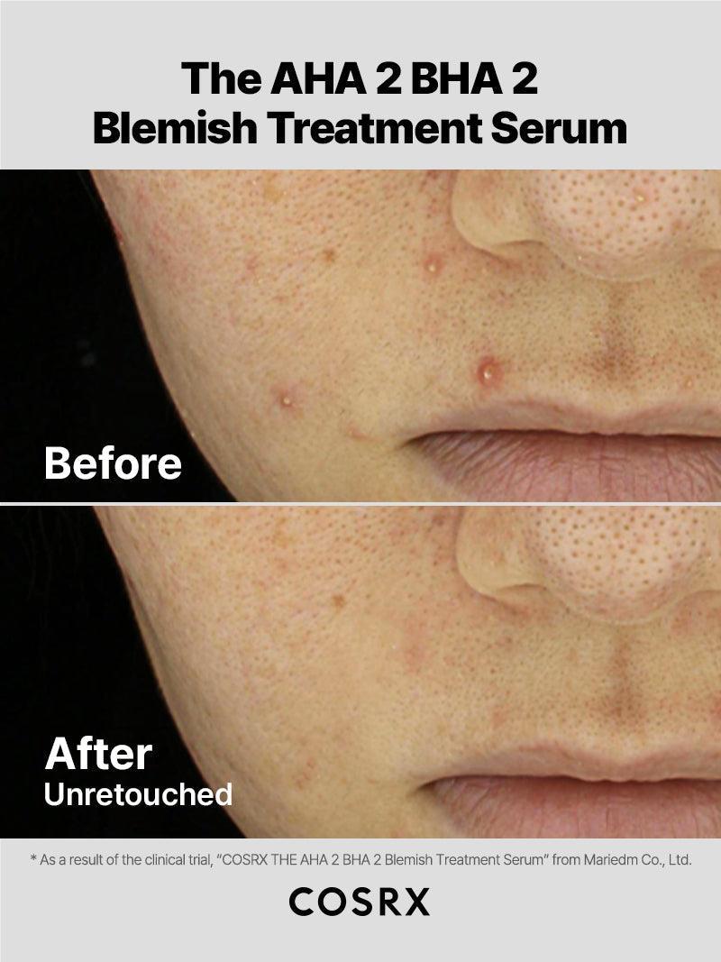 cosrx-aha-2-bha-2-blemish-treatment-serum-pickelserum image 3