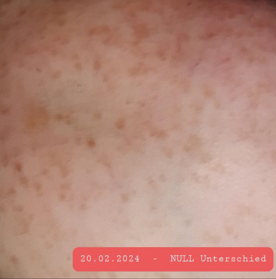 Pickelmale endlich blasser